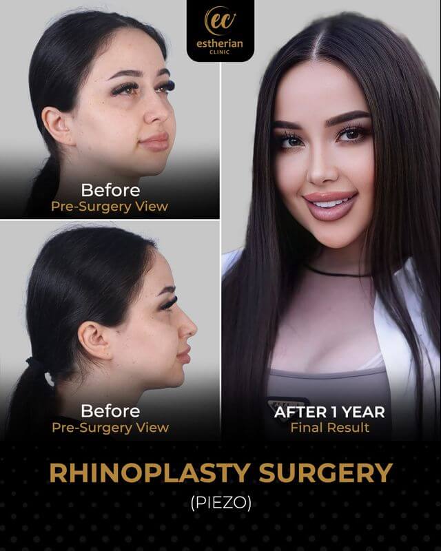 Rhinoplasty surgery by the Estherian Clinic (real patient results)