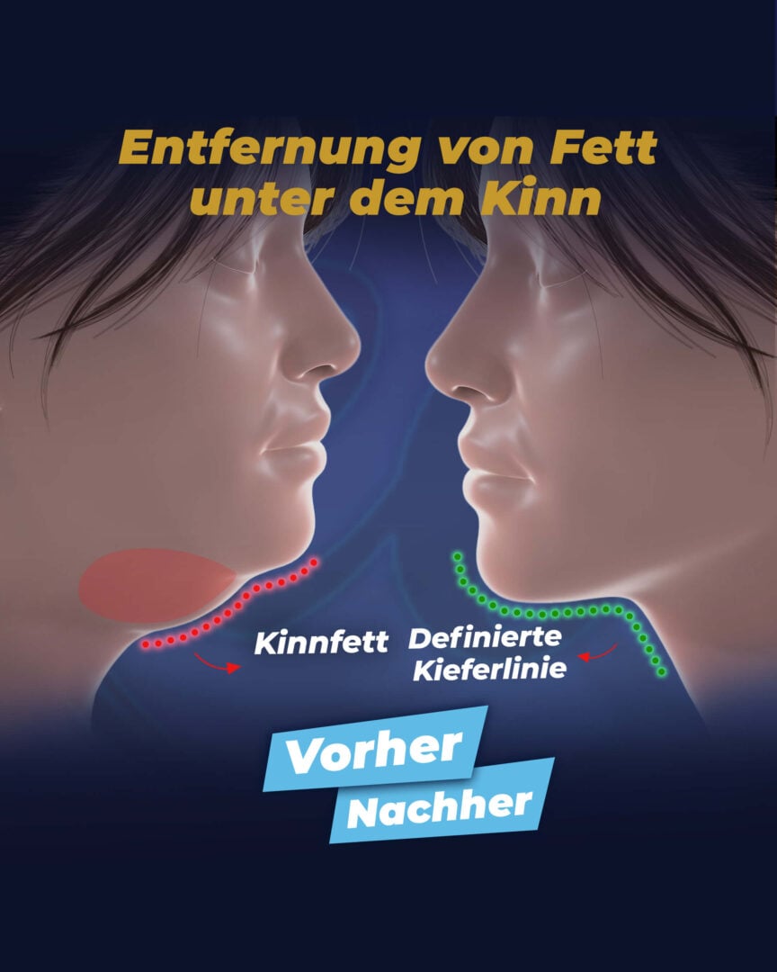 Unterkinnfettentfernung durch die Estherian-Klinik