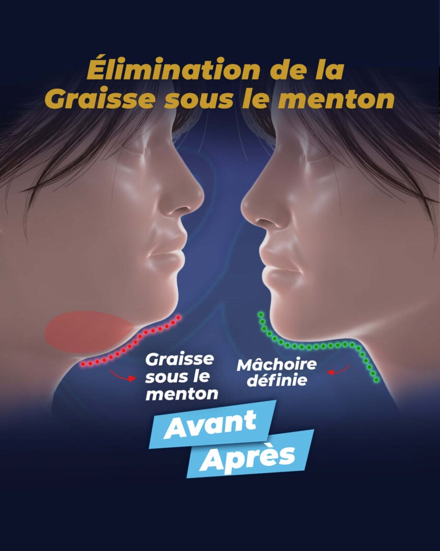 Élimination de la graisse sous le menton par la clinique Estherian