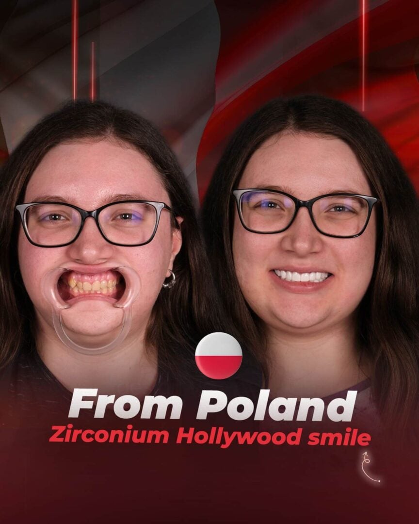 Zirconium Hollywood Smile by the Estherian Clinic