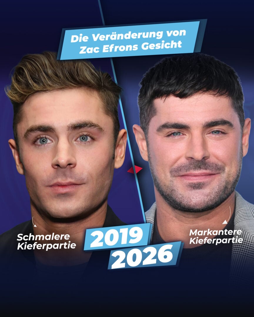 Zac Efrons Gesichtsveränderung (damals und heute) vor und nach der Operation