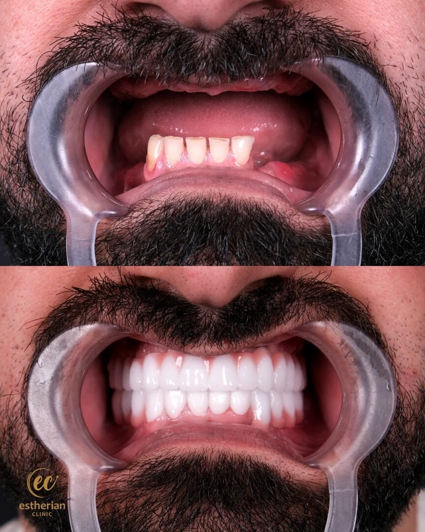 11 زرعة أسنان و26 سنًا مرصعة بالزركونيوم لابتسامة هوليوود من عيادة إستيريان