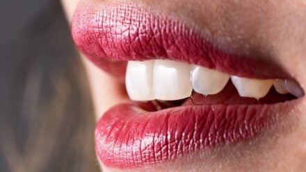 All About the Maintenance of Veneers