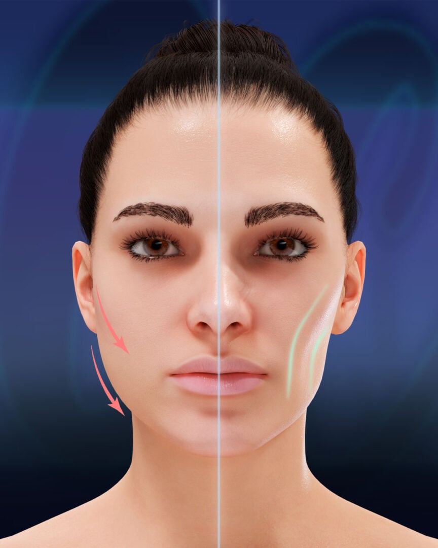 Bichectomy Infographic