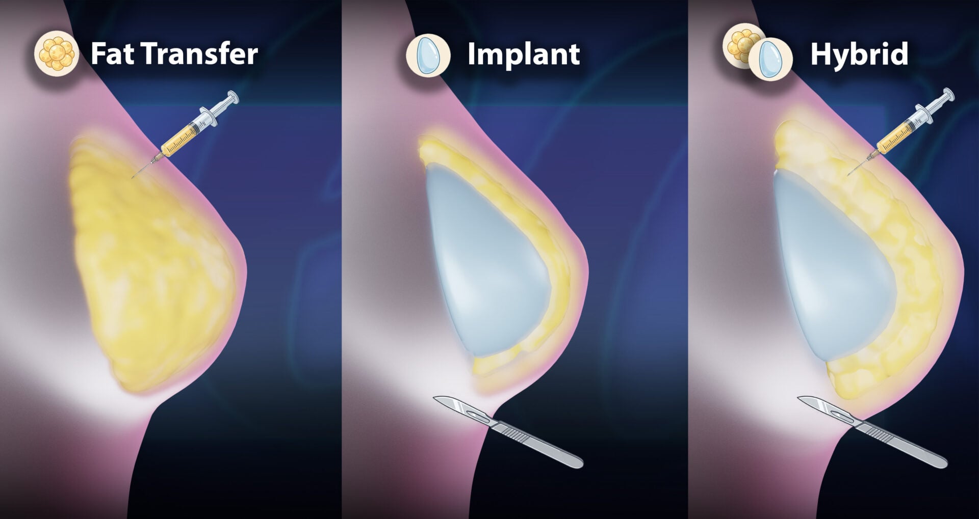 Breast Augmentation Options