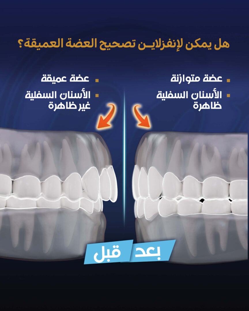 هل يمكن لتقويم الأسنان الشفاف (Invisalign) أن يعالج العضة العميقة؟