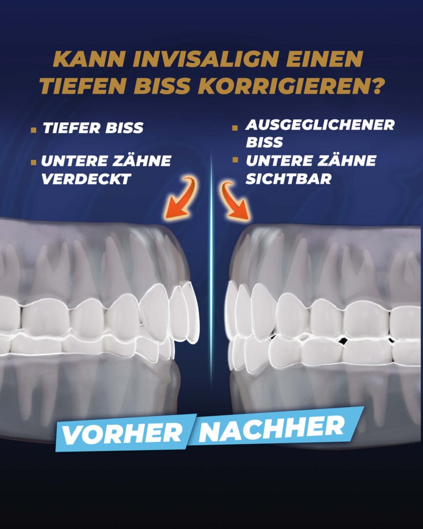 Kann Invisalign einen Überbiss korrigieren? (Estherian)