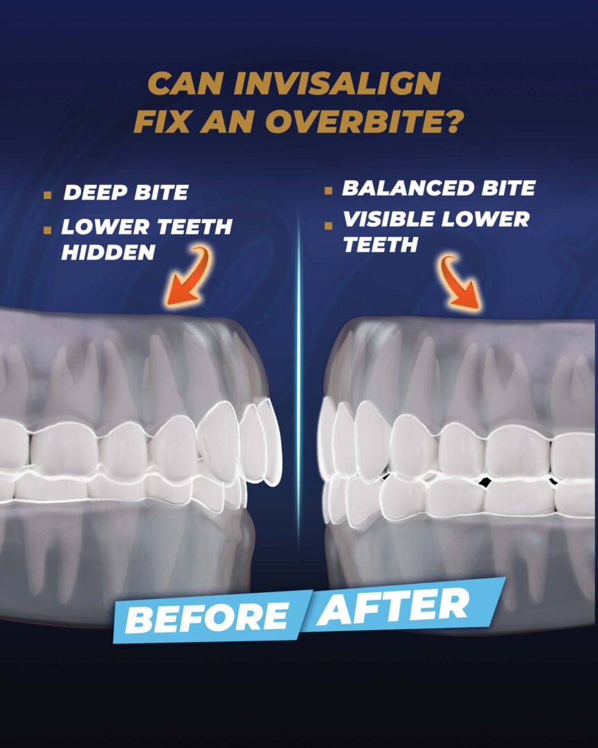 Can-Invisalign-fix-an-overbite-estherian