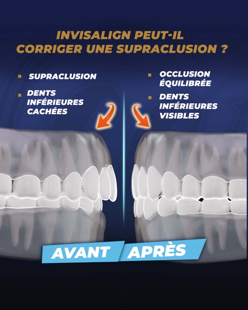 Est-Invisalign peut-il corriger une surocclusion ? - Estherian