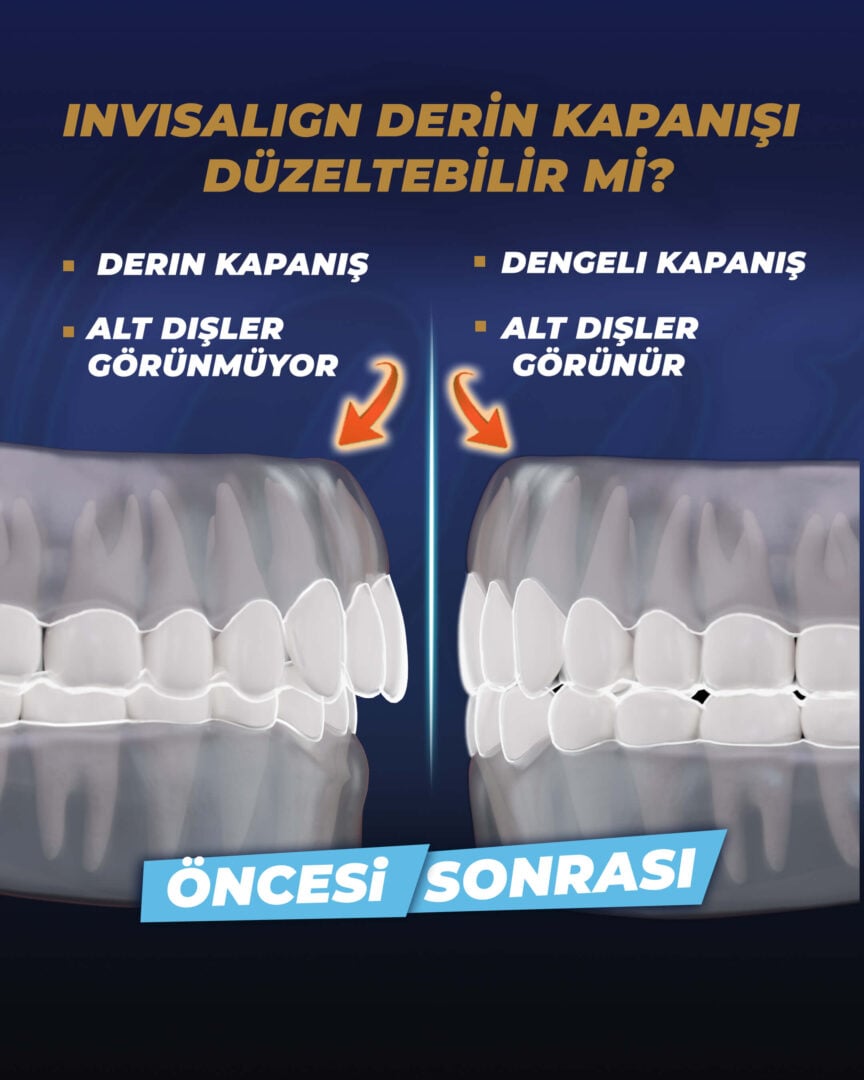 Invisalign, estherian tipi üst çene çıkığını düzeltebilir mi?