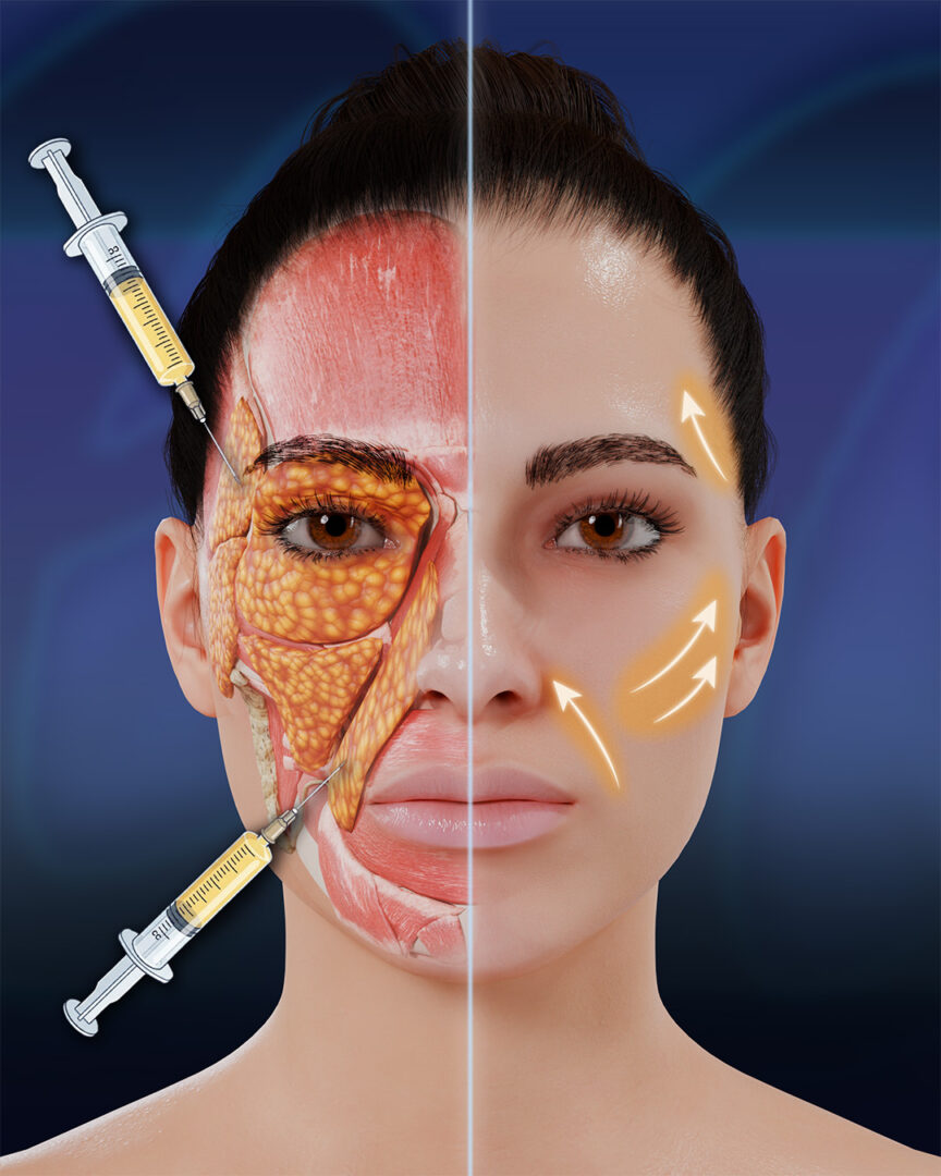 Face Fat Injection Infographic