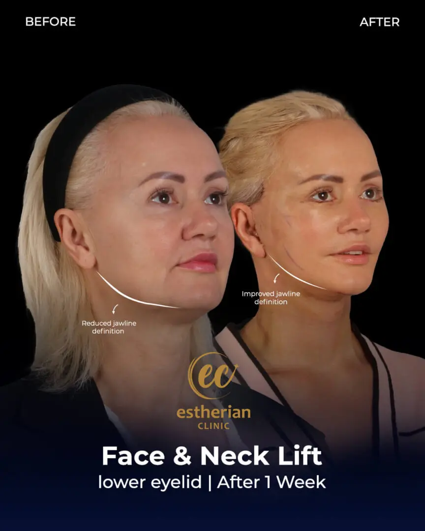 Vorher-Nachher-Fotos von Gesichts- und Halsstraffung der Estherian Clinic