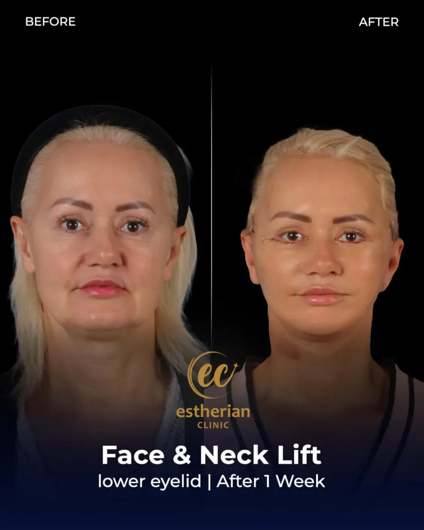Vorher-Nachher-Foto einer Gesichts- und Halsstraffung (Erfolgsgeschichte einer Patientin) der Estherian Klinik
