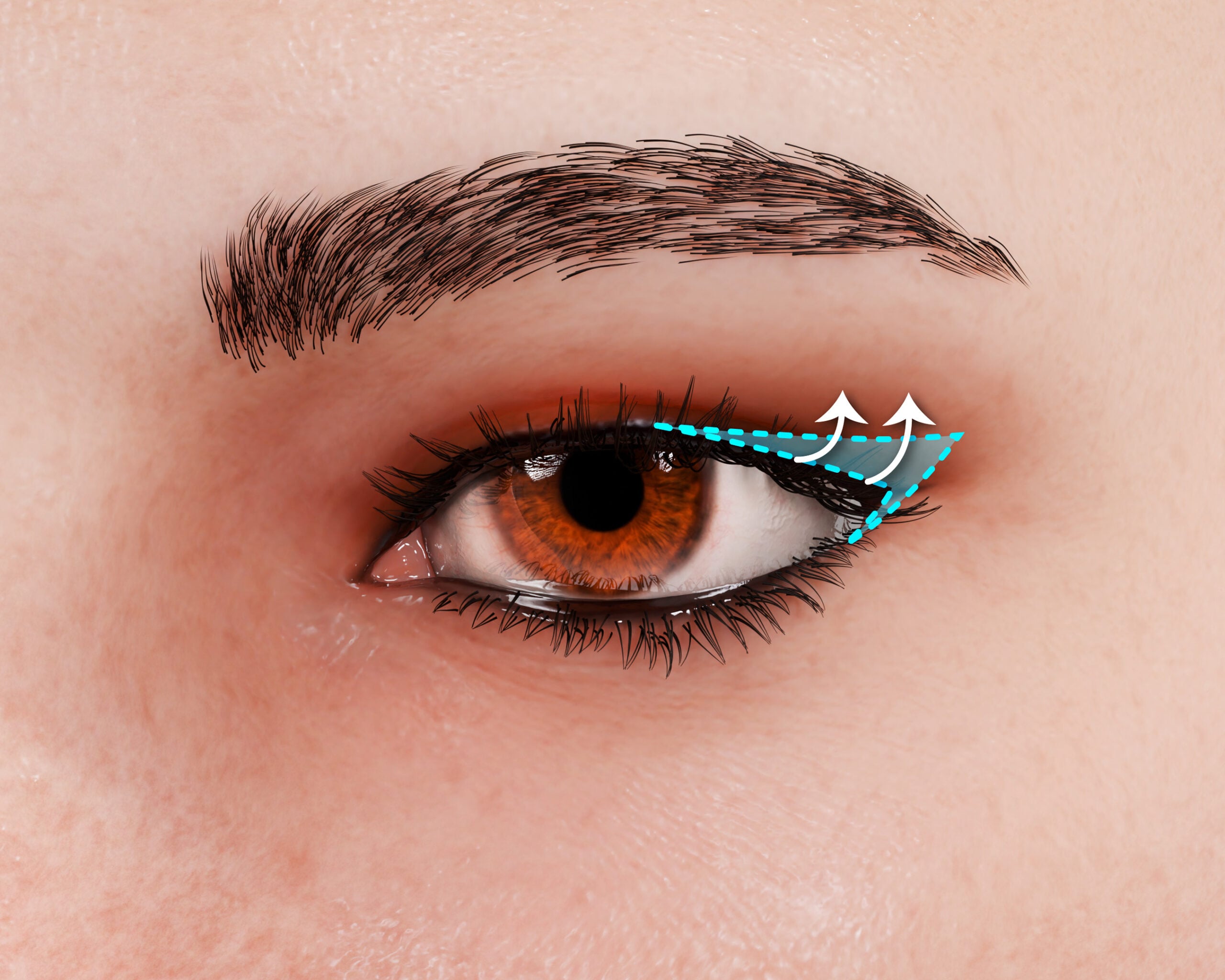 Fox Eye Surgery Canthoplasty Infographic