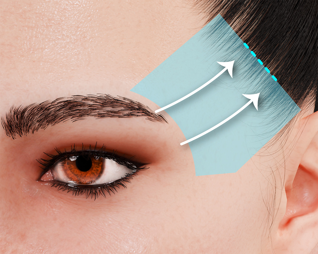 Fox Eye Surgery Temporal Lift Infographic