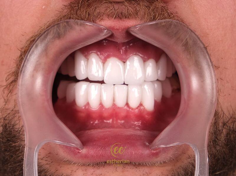 نتائج عملية تجميل الابتسامة على طريقة هوليوود (قبل وبعد) من عيادة إستيريان