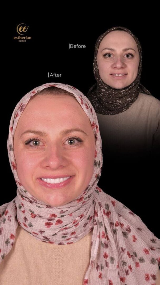 Résultats du relooking du sourire hollywoodien (avant et après) par la clinique Estherian