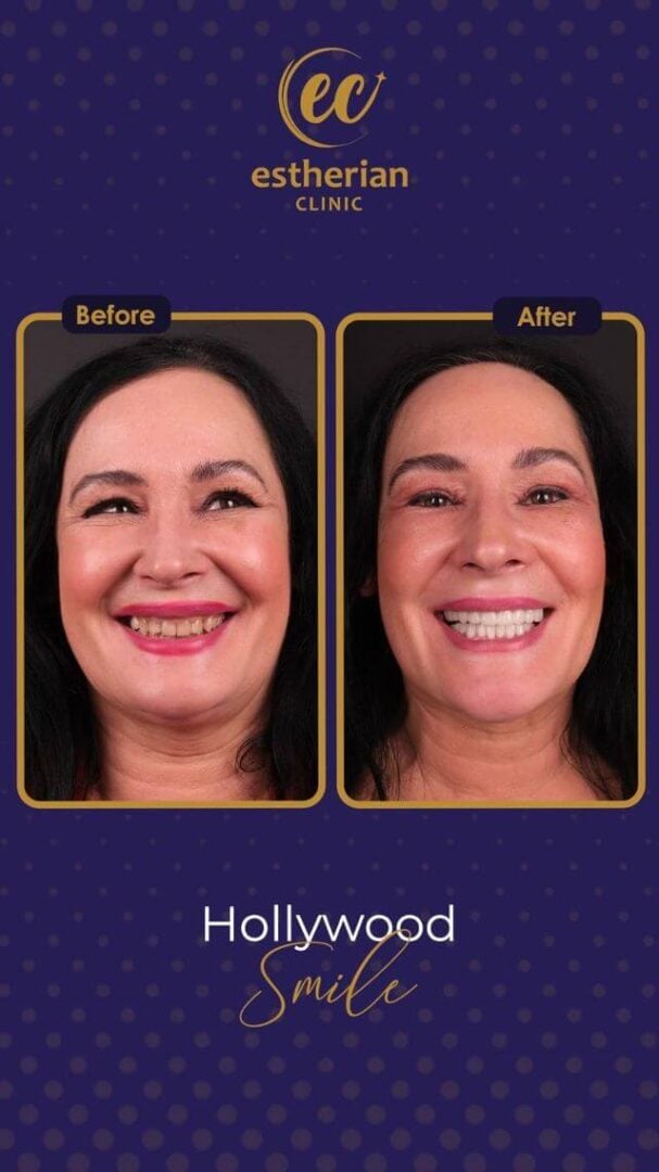 Hollywood Smile Transformation (real patient before-and-after photo) by the Estherian Clinic