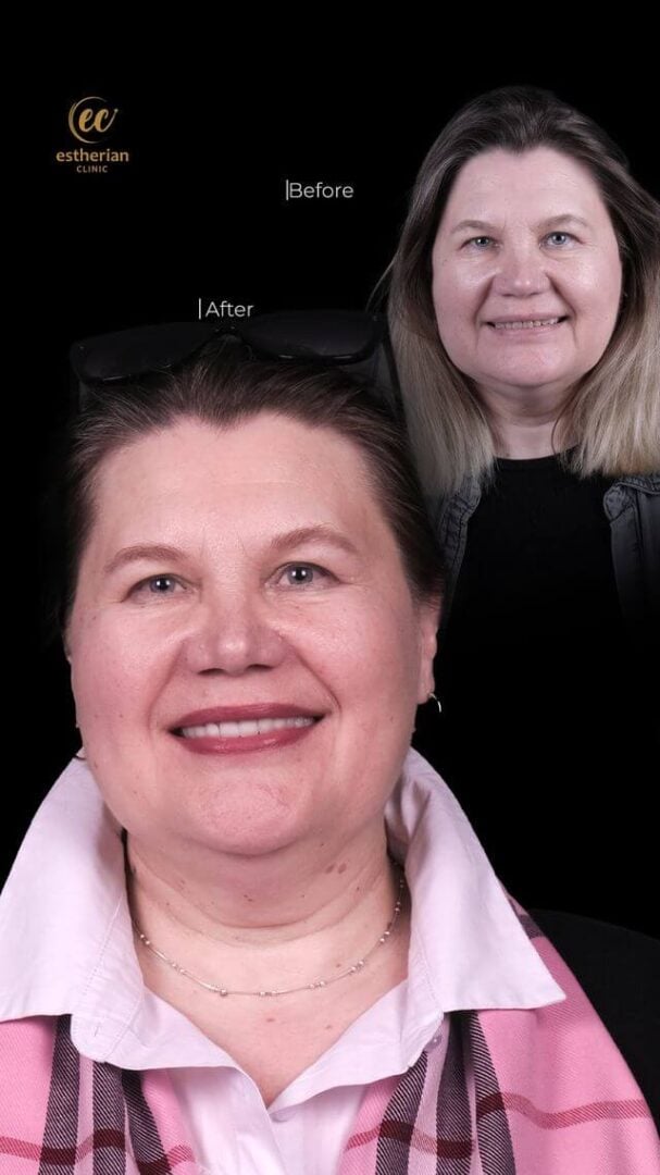 Résultats du Hollywood Smile (avant et après) par la clinique Estherian