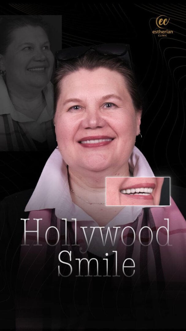 Hollywood Smile (real patient before-and-after photo) by the Estherian Clinic