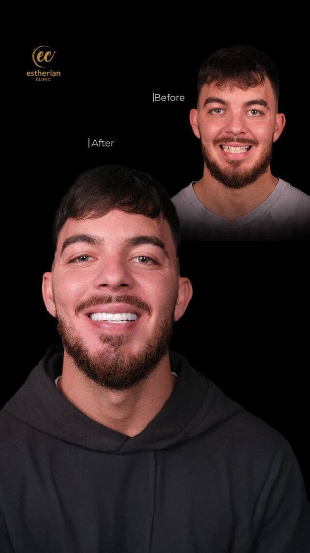 Hollywood Smile (real patient results, before-and-after photo) by the Estherian Clinic