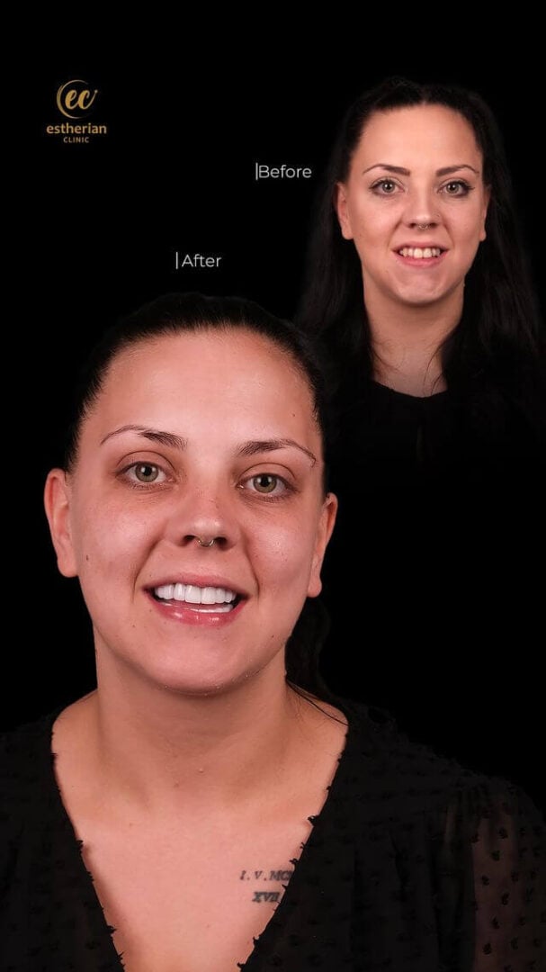Hollywood smile before and after transformation by the Estherian Clinic