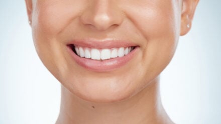 How Long Do Veneers Last