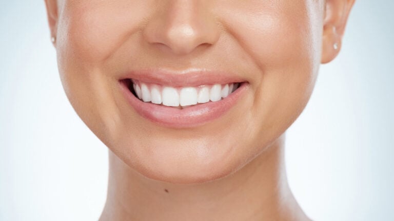 How Long Do Veneers Last