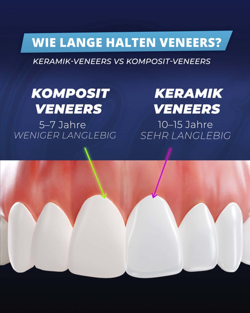Wie lange halten Veneers? Infografik der Estherian Clinic