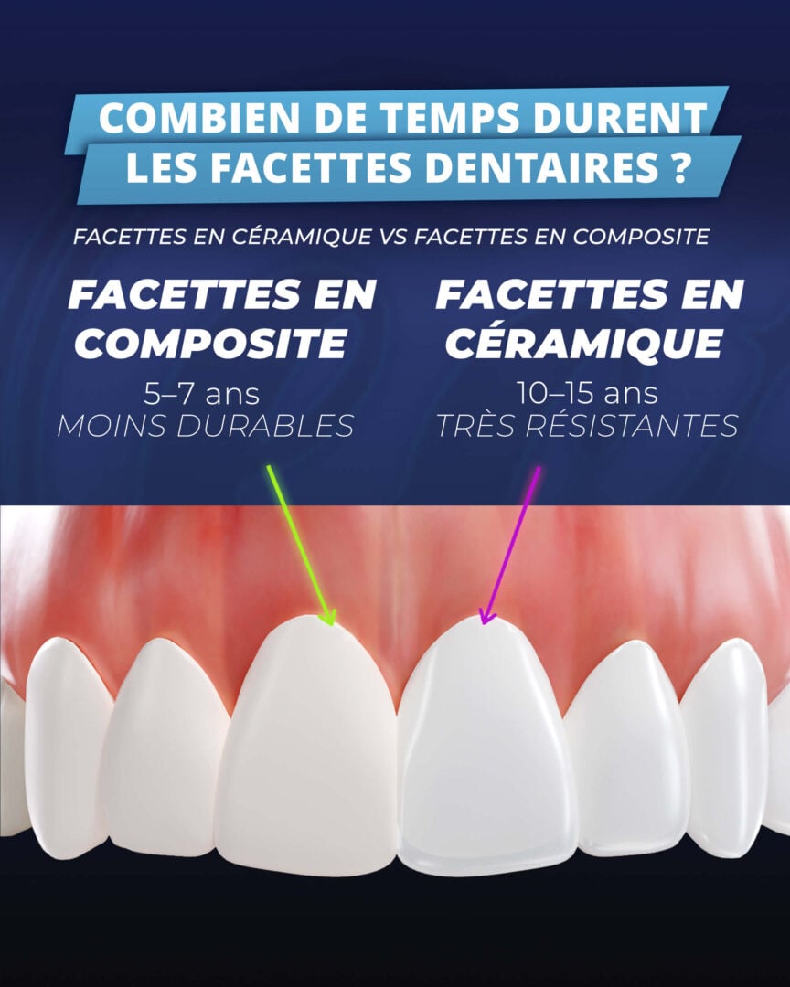Combien de temps durent les facettes dentaires ? Infographie de la clinique Estherian