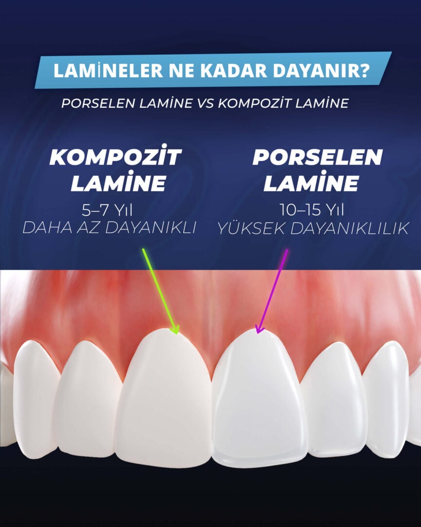 Porselen Kaplamalar Ne Kadar Süre Dayanır? Estherian Kliniği tarafından hazırlanan bilgi grafiği.