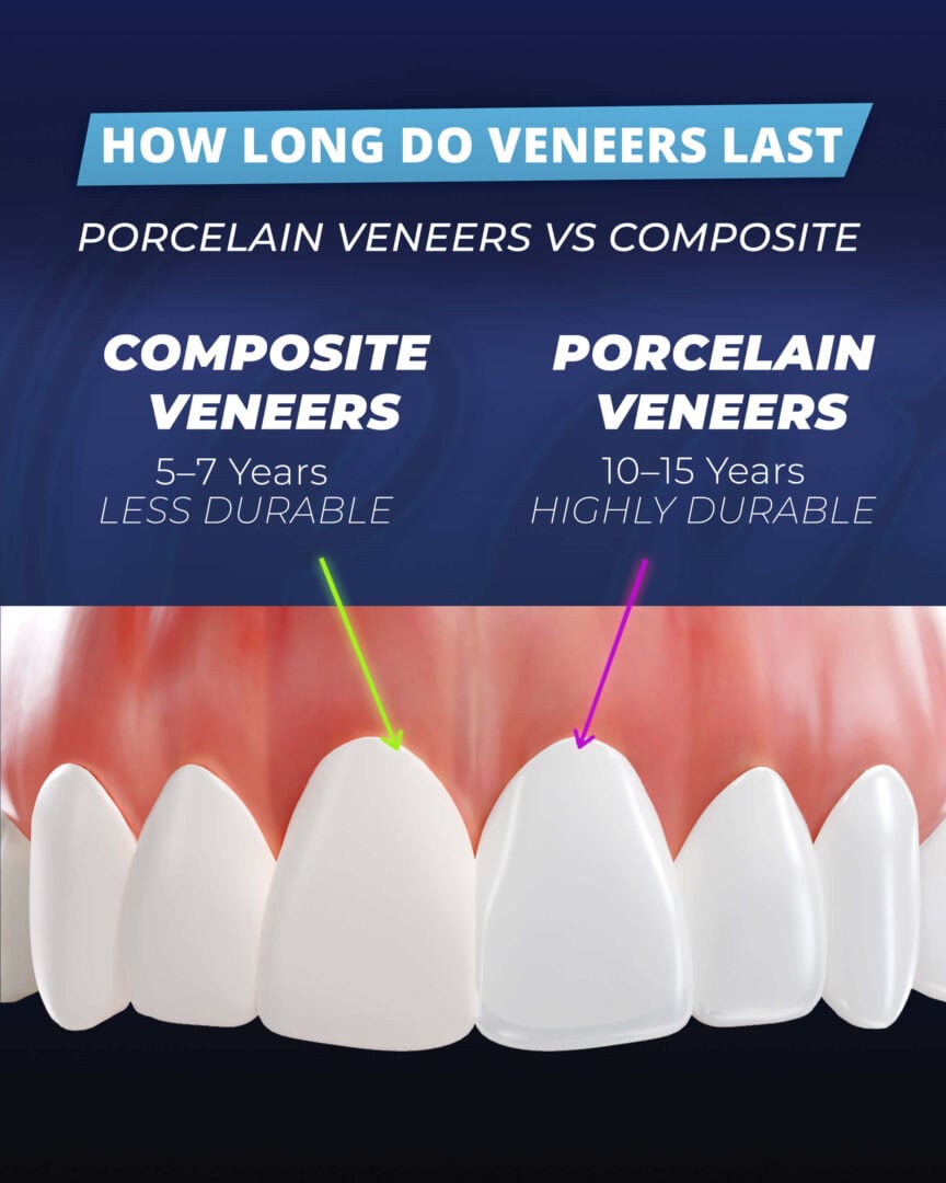 How-Long-Do-Veneers-Last? Infographic by the Estherian Clinic