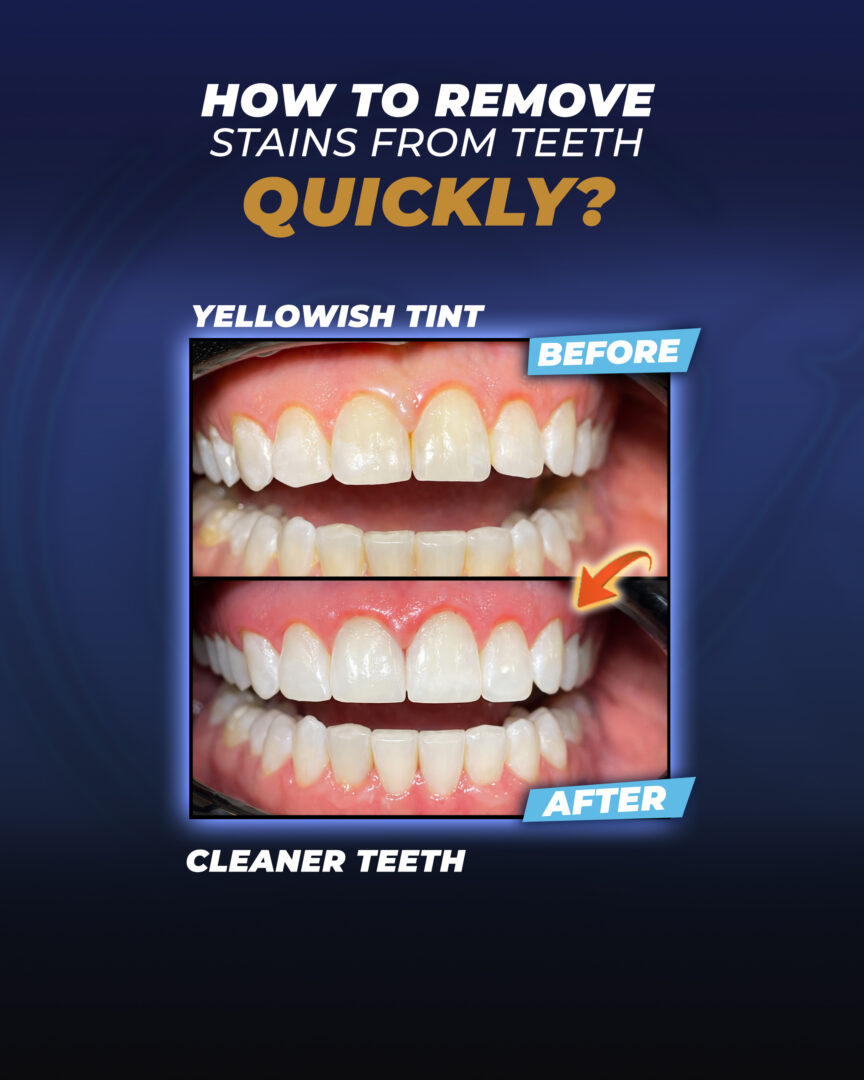 How-to-Remove-Brown-Stains-from-Teeth-Naturally?