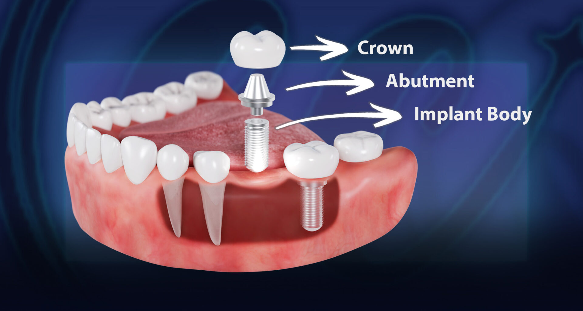 Dental Implant Body Abutment and Crown