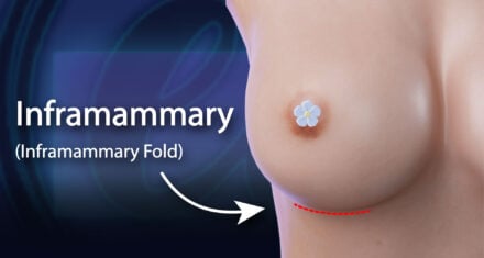 Inframammary Incision: Beneath the breast, just above the crease.