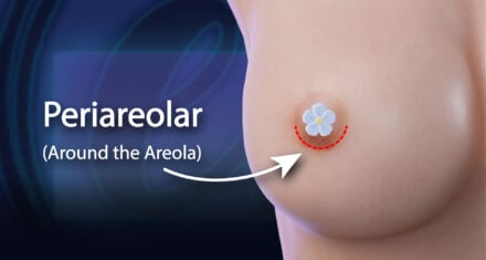 Periareolar Incision: Around the lower edge of the areola.