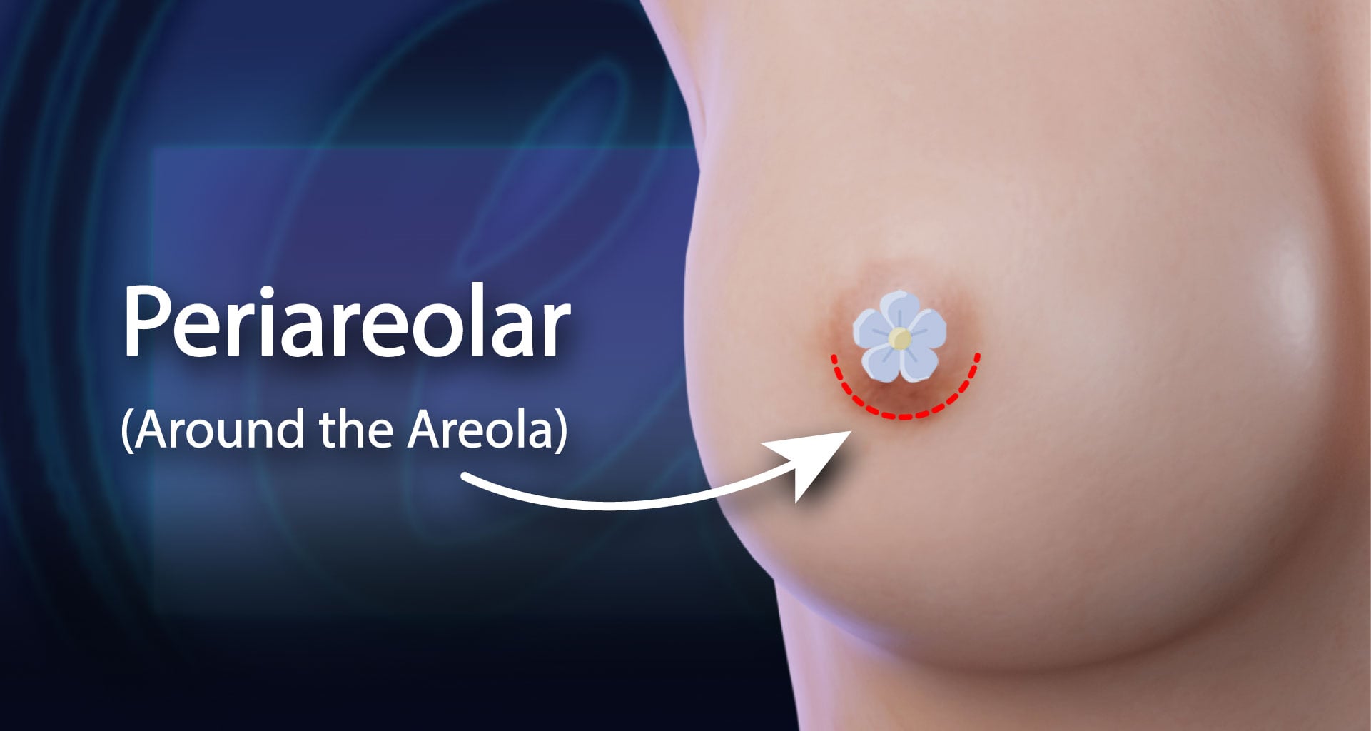 Periareolar Incision Infographic