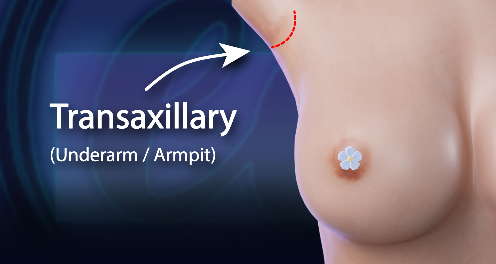 Transaxillary Incision Infographic