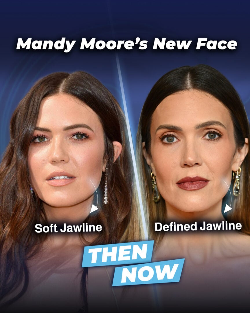 Mandy Moore before and after face