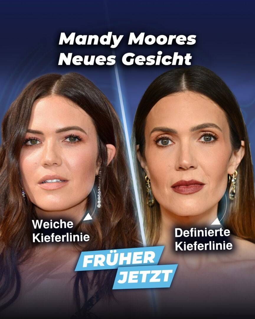 Mandy Moore – Gesicht vorher und nachher
