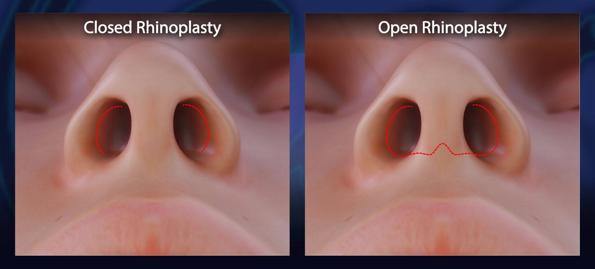 Closed and Open Rhinoplasty Incision Sites