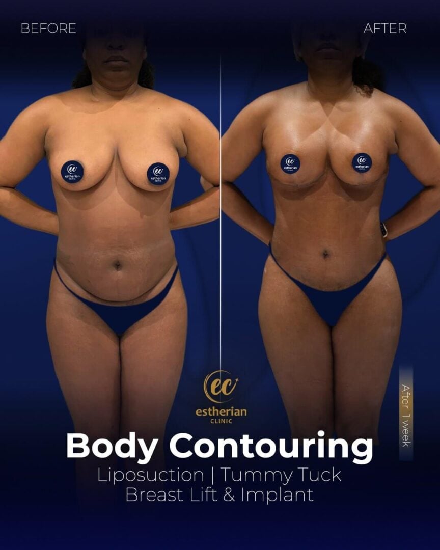 tummy tuck, liposuction, and breast lift with implants