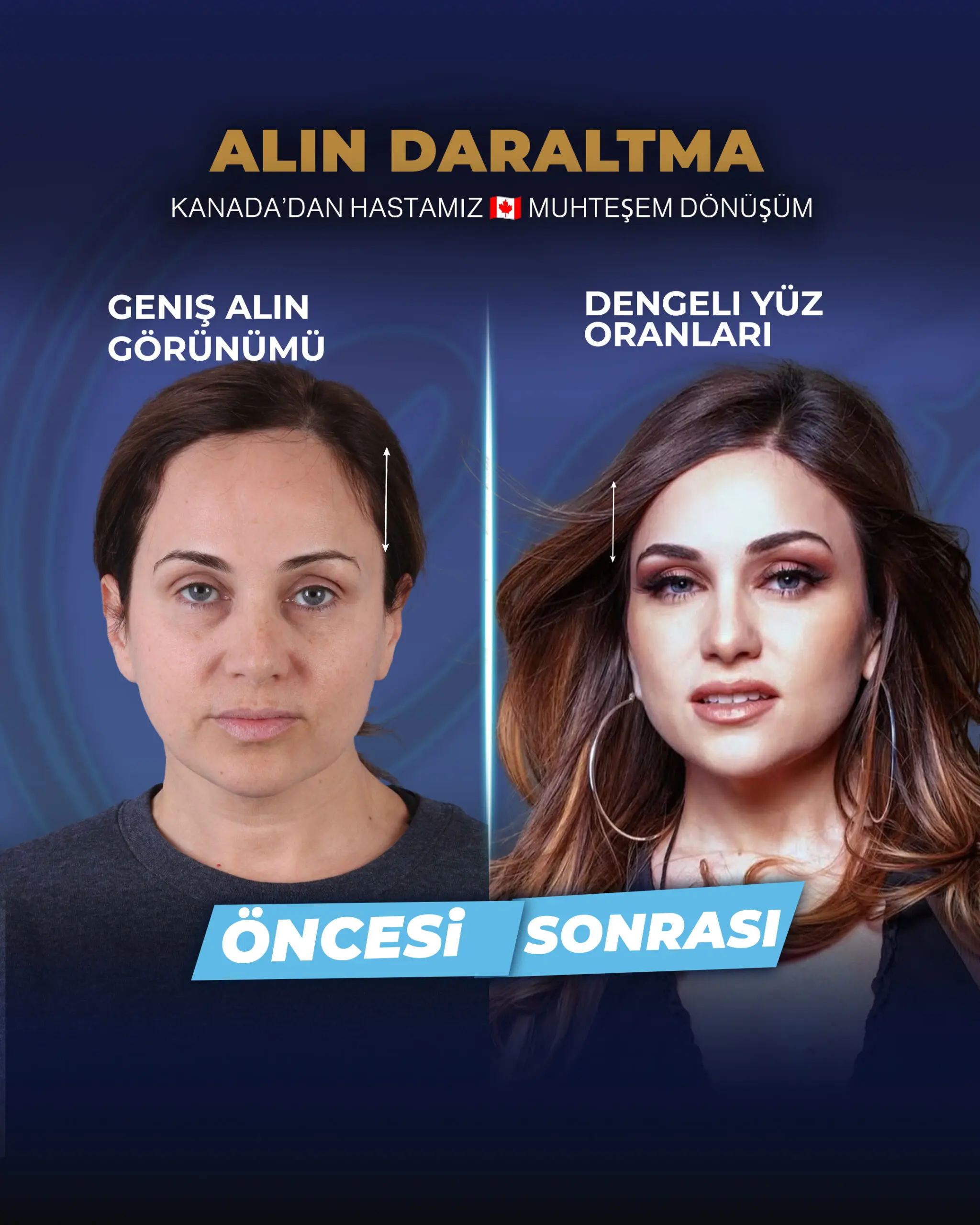 Estherian Kliniği tarafından gerçekleştirilen gerçek alın küçültme ameliyatı sonrası hasta dönüşümü.