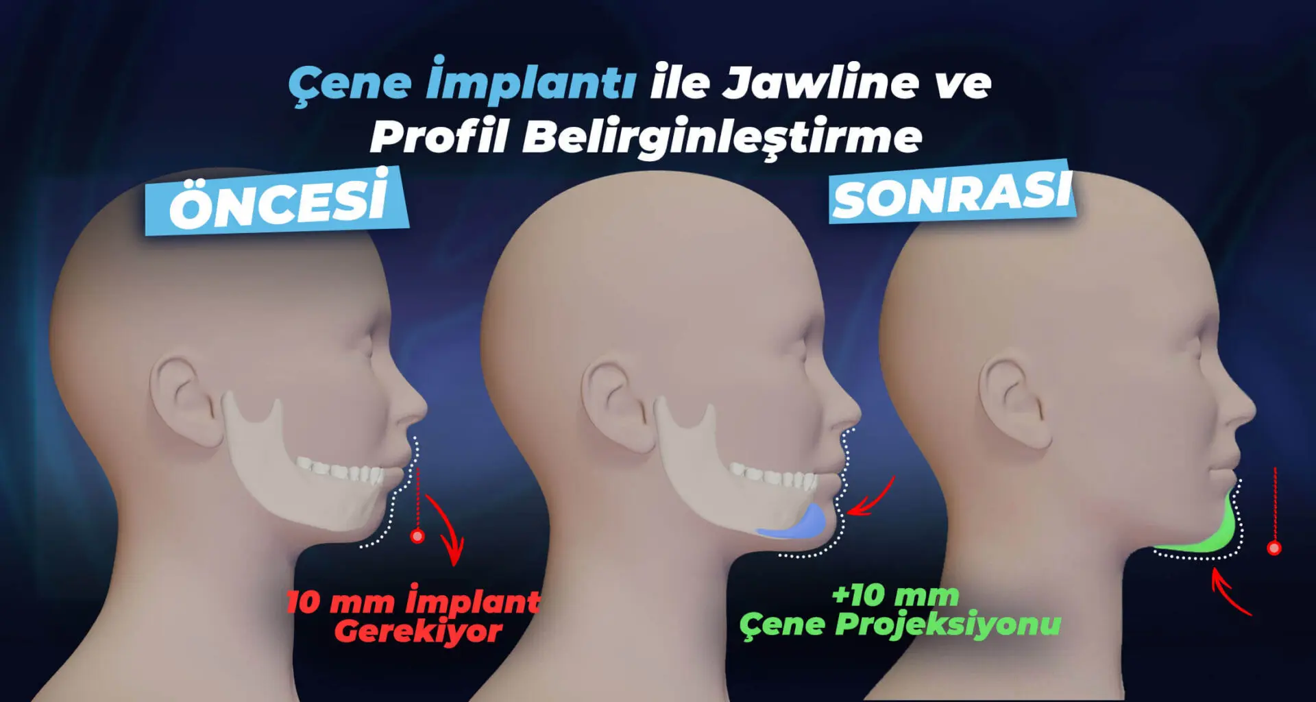 Estherian Kliniği tarafından yapılan Çene İmplantı İşlemi