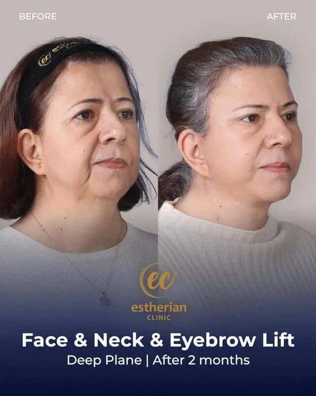 Face, neck and browlift (results after 2 months) by the Estherian Clinic