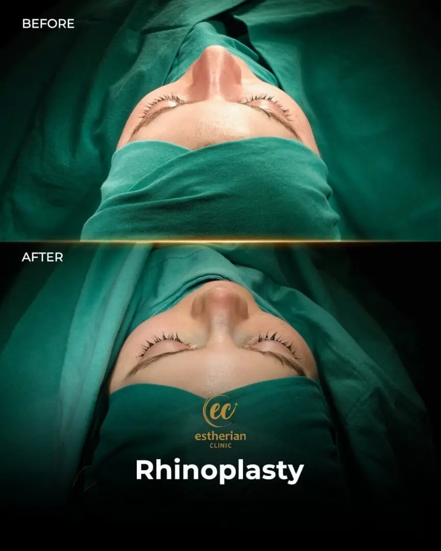 Facial Plastic Surgery Results - Rhinoplasty by the Estherian Clinic