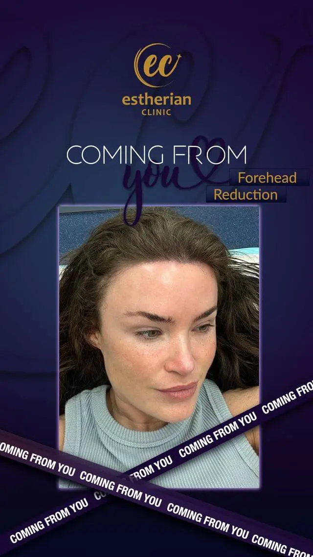 Forehead Reduction Surgery (Real Patient Transformation) by the Estherian Clinic