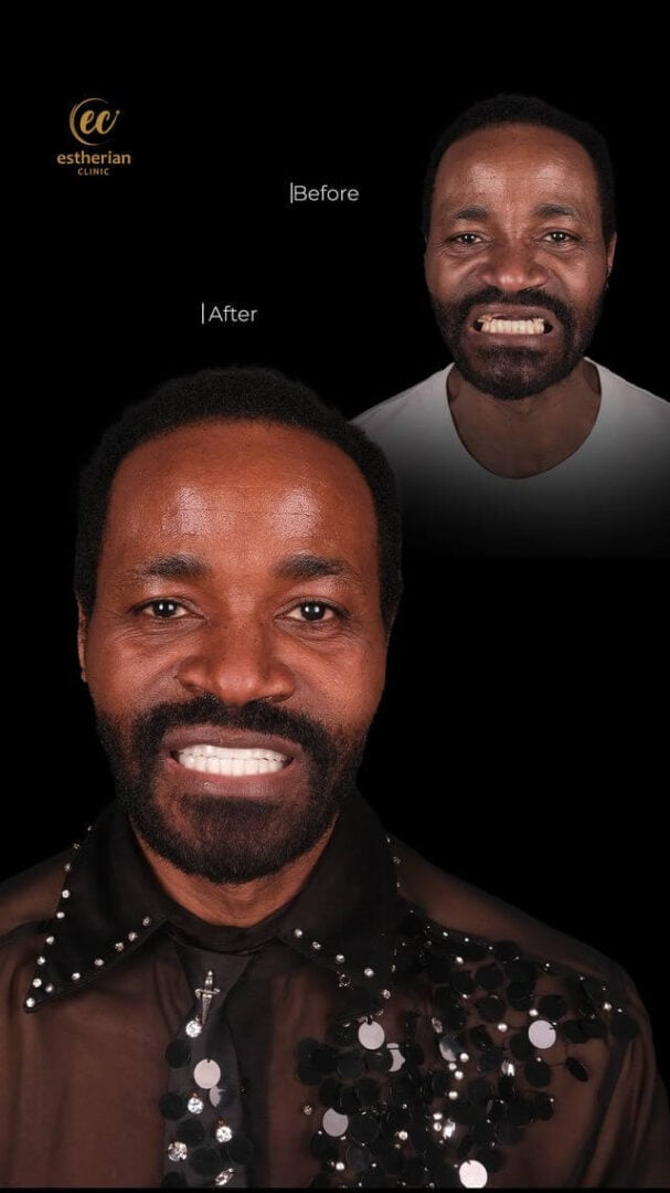 Hollywood Smile Treatment by the Estherian Clinic