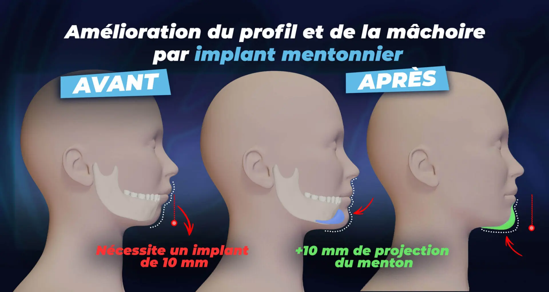 Intervention d'implant mentonnier à la clinique Estherian