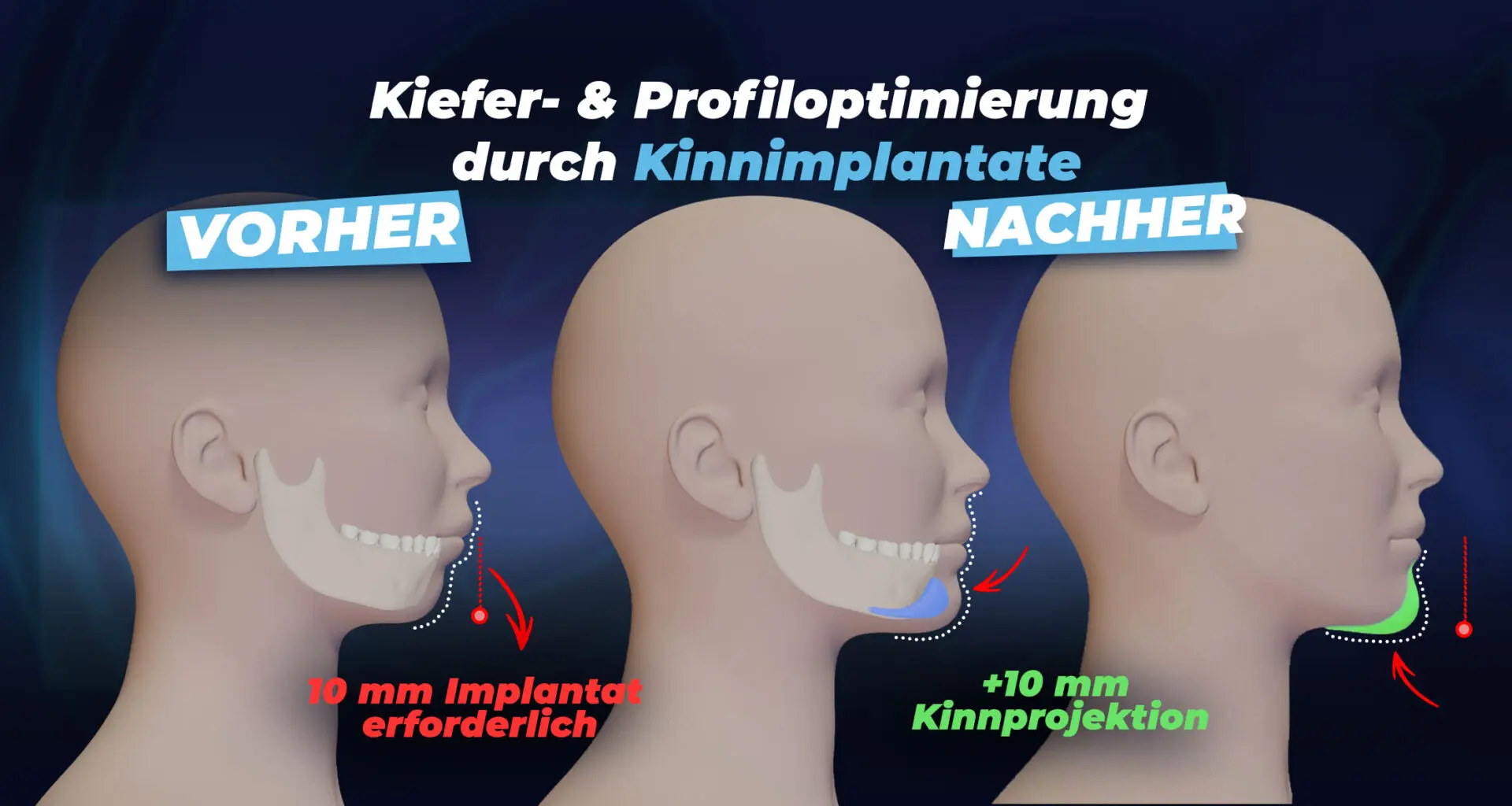 Kinnimplantat-Verfahren durch die Estherian-Klinik